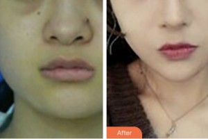 荊門中翰整形美容醫(yī)院李小丹整形價(jià)格表附埋線提升案例展示