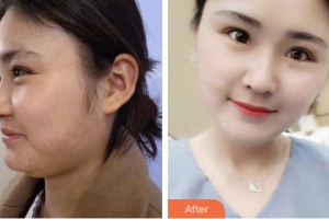 荊門市第一人民醫(yī)院醫(yī)學(xué)美容中心謝和新整形價(jià)格表附超聲提拉案例展示