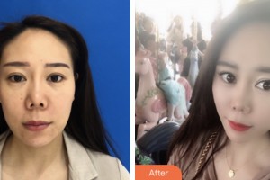 荊門中翰整形美容醫(yī)院胡文亞整形價(jià)格表附埋線提升案例展示