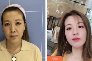 荊門市第二人民醫(yī)院醫(yī)學(xué)整形美容中心金娟娟整形價(jià)格表附埋線提升案例展示