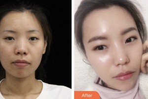 荊門市第二人民醫(yī)院醫(yī)學(xué)整形美容中心王金波整形價(jià)格表附熱瑪吉案例展示