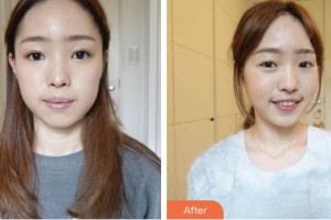 荊門市第二人民醫(yī)院醫(yī)學(xué)整形美容中心李成龍整形價(jià)格表附埋線提升案例展示