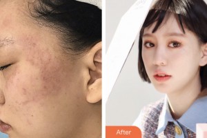 荊門市第二人民醫(yī)院醫(yī)學(xué)整形美容中心戴明英整形價(jià)格表附激光美膚激光案例展示