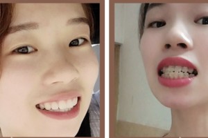 荊門市第二人民醫(yī)院醫(yī)學(xué)整形美容中心葉君整形價(jià)格表附冷光美白案例展示