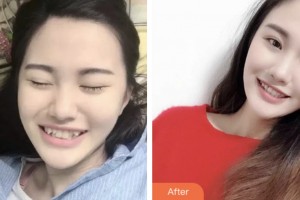 荊門鐘祥佳美醫(yī)療美容門診部李玖玲整形價(jià)格表附金屬托槽矯正案例展示