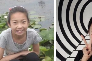 荊門鐘祥佳美醫(yī)療美容門診部趙元杰整形價(jià)格表附金屬托槽矯正案例展示