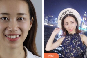 荊門小白兔口腔醫(yī)院趙宗富整形價(jià)格表附牙齒隱形矯正案例展示