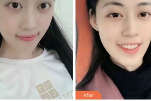 荊門好美醫(yī)療美容醫(yī)院葉華整形價(jià)格表附美白貼片案例展示