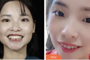 荊門好美醫(yī)療美容醫(yī)院謝鎮(zhèn)安整形價(jià)格表附金屬托槽矯正案例展示