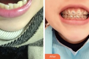 荊門亞貝特口腔醫(yī)院高龍整形價(jià)格表附金屬托槽矯正案例展示