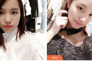 荊門小白兔口腔醫(yī)院廖開禹整形價(jià)格表附牙齒隱形矯正案例展示