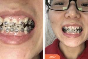 荊門小白兔口腔醫(yī)院李雪明整形價格表附金屬托槽矯正案例展示