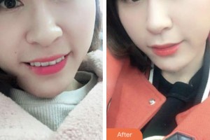 荊門小白兔口腔醫(yī)院黃玲整形價格表附牙齒隱形矯正案例展示