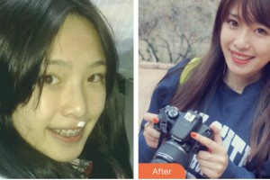 荊門小白兔口腔醫(yī)院蘇軼心整形價格表附金屬托槽矯正案例展示