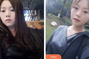 荊門小白兔口腔醫(yī)院朱懷紅整形價格表附牙齒隱形矯正案例展示