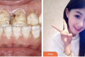 荊門小白兔口腔醫(yī)院易君整形價格表附超聲波潔牙案例展示