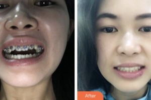 荊門市口腔醫(yī)院丁少華整形價格表附金屬托槽矯正案例展示