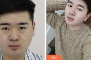 株洲藝佳醫(yī)療美容?？漆t(yī)院李文軍整形價(jià)格表附假體隆鼻案例展示