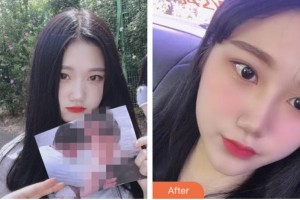 株洲藝佳醫(yī)療美容?？漆t(yī)院高謝輝整形價(jià)格表附耳軟骨復(fù)合隆鼻案例展示