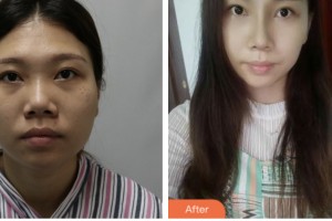 株洲嘉美醫(yī)療整形美容診所鄧曉林整形價(jià)格表附鼻部綜合案例展示