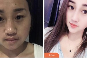 株洲市一醫(yī)院燒傷整形外科蘇開新整形價格表附鼻部綜合案例展示