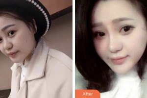 株洲華美整形醫(yī)美容醫(yī)院張涵整形價格表附鼻部綜合案例展示