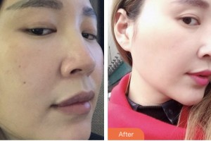 株洲中雅醫(yī)療美容門診部周唯鈞整形價(jià)格表附鼻部綜合案例展示