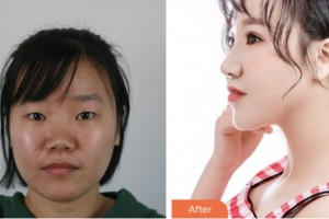 株洲市中心醫(yī)院整形美容科黃挺整形價(jià)格表附耳軟骨復(fù)合隆鼻案例展示