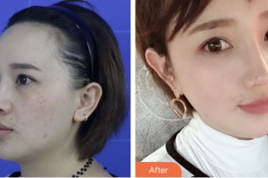 株洲市中心醫(yī)院整形美容科歐陽霞整形價(jià)格表附鼻部綜合案例展示