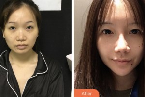 株洲市中心醫(yī)院整形美容科靳海濤整形價(jià)格表附鼻部綜合案例展示