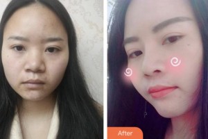 株洲愛思特醫(yī)療美容醫(yī)院張新成整形價(jià)格表附鼻部綜合案例展示