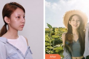 株洲宇芳姬醫(yī)療美容門診部歐陽甜整形價(jià)格表附硅膠隆鼻案例展示