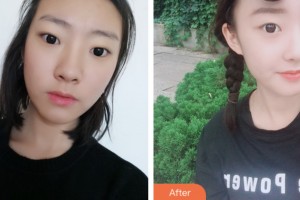 株洲宇芳姬醫(yī)療美容門診部鄭蕎安整形價(jià)格表附鼻部綜合案例展示