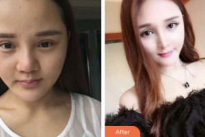 株洲宇芳姬醫(yī)療美容門診部李鶴整形價(jià)格表附鼻部綜合案例展示