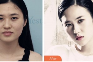 株洲韓美醫(yī)療美容醫(yī)院胡明科整形價(jià)格表附鼻部綜合案例展示