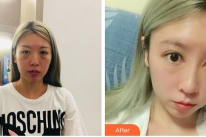 株洲韓美醫(yī)療美容醫(yī)院向平整形價(jià)格表附鼻部綜合案例展示