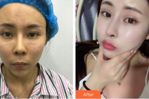 株洲雅美醫(yī)療美容門診部車旺整形價格表附鼻修復(fù)案例展示
