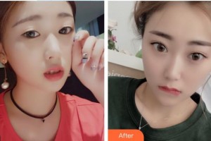 泰州泰勒美整形美容醫(yī)院張曉窗整形價格表附美容冠案例展示