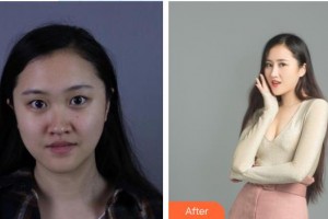 泰州第四人民醫(yī)院整形美容分院錢春華整形價格表附鼻部綜合案例展示