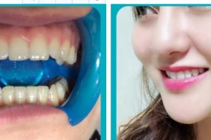 泰州泰勒美整形美容醫(yī)院王志忠整形價格表附冷光美白案例展示