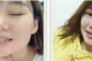 泰州第四人民醫(yī)院整形美容分院董磊整形價格表附牙齒隱形矯正案例展示