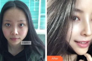 泰州麗都醫(yī)療美容醫(yī)院丁光攝整形價格表附肋軟骨隆鼻案例展示