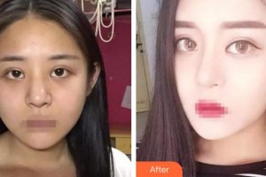 泰州麗都醫(yī)療美容醫(yī)院李鎮(zhèn)鎬整形價格表附鼻部綜合案例展示