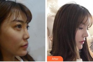 泰州麗都醫(yī)療美容醫(yī)院洪基石整形價格表附鼻部綜合案例展示