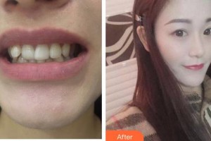 泰州麗都醫(yī)療美容醫(yī)院朱基標整形價格表附牙貼面案例展示