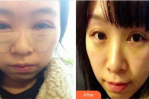 泰州市人民醫(yī)院燒傷整形科孫步梅整形價格表附外切祛眼袋案例展示