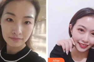 泰州張勤眼科醫(yī)院醫(yī)療美容中心張勤整形價格表附眼部綜合案例展示