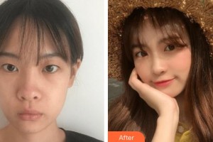 泰州張勤眼科醫(yī)院醫(yī)療美容中心耿瑞整形價格表附切開雙眼皮案例展示