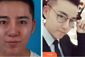 泰州愛爾眼科醫(yī)院郁素蘭整形價格表附內切祛眼袋案例展示