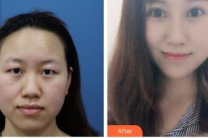 泰州麗都醫(yī)療美容醫(yī)院劉俠整形價格表附切開雙眼皮案例展示